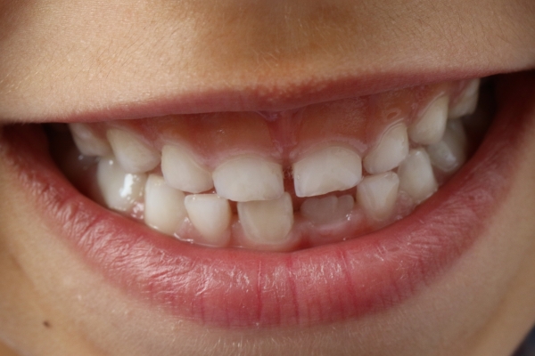 Kieferorthopädische Behandlung - warum Kinder eine Zahnzusatzversicherung haben sollten
